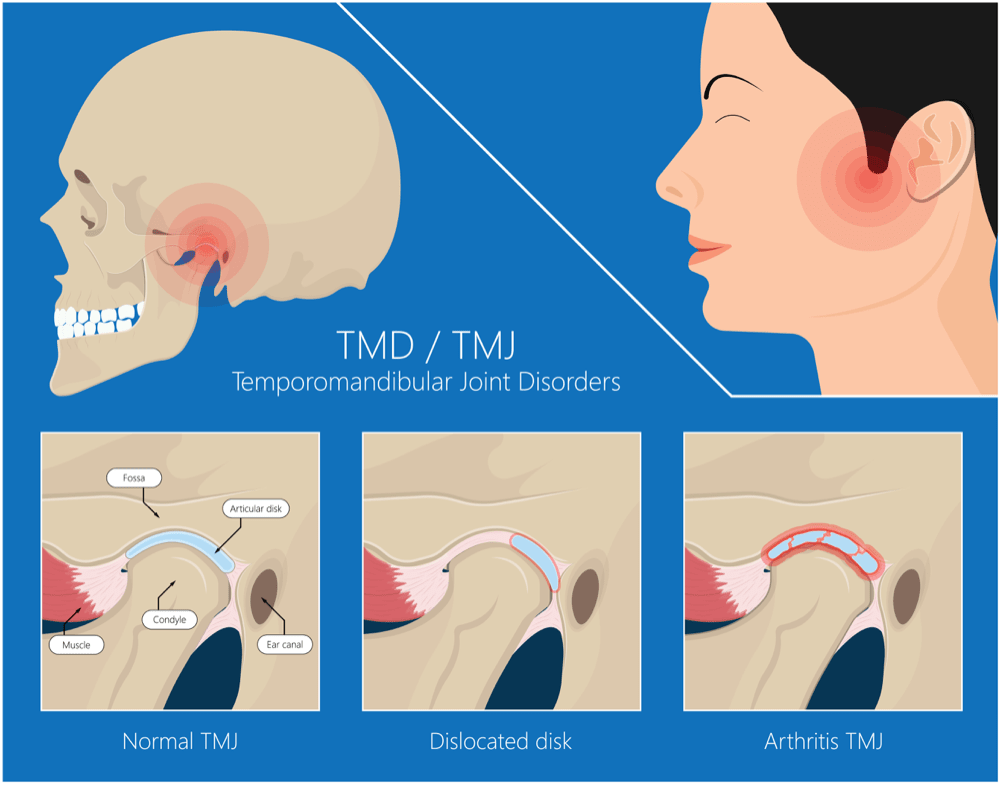 Jaw Popping and What Can I Do?