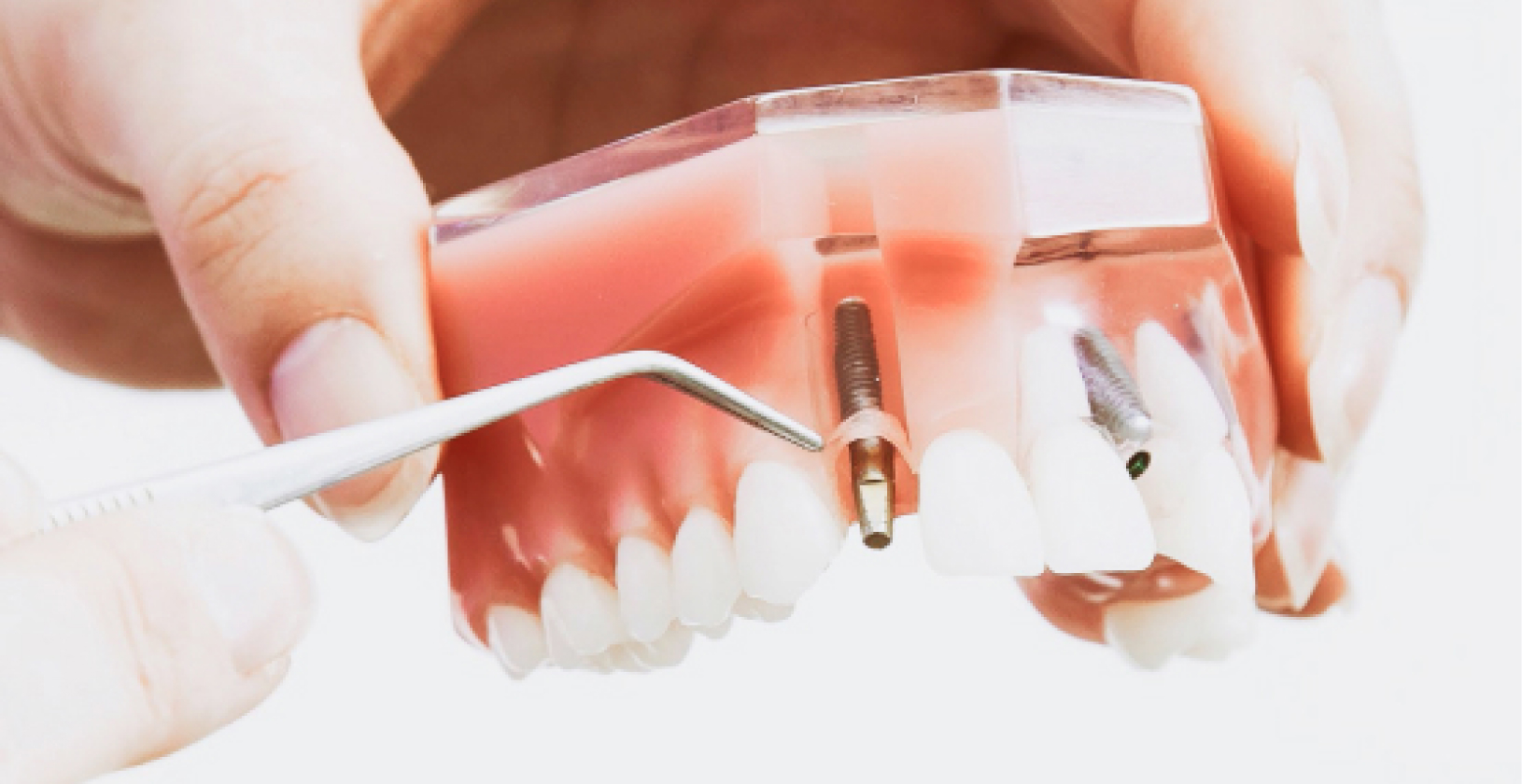 Tandara Dental Implant vs Dental Bridge  How to Choose the Best Option for You