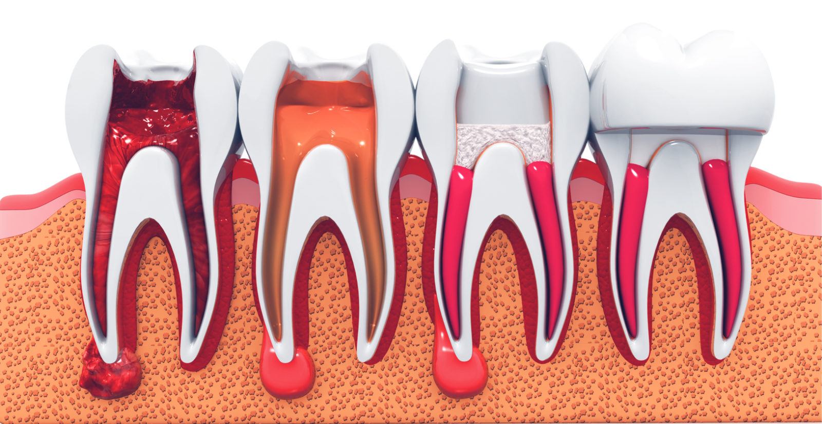 Tandara Dental Root Canals e1635753920153